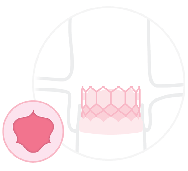 Diagram SAPIEN TAVR System